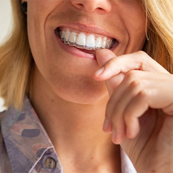 A woman putting clear aligners over her teeth