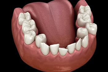 A computer illustration depicting crowded teeth