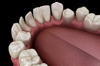 A computer illustration showing spaces between teeth