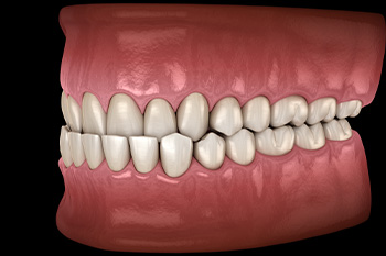 A computer illustration showing underbite