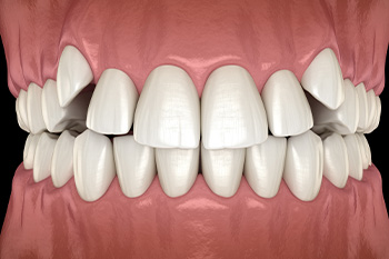 A computer illustration showing misaligned teeth