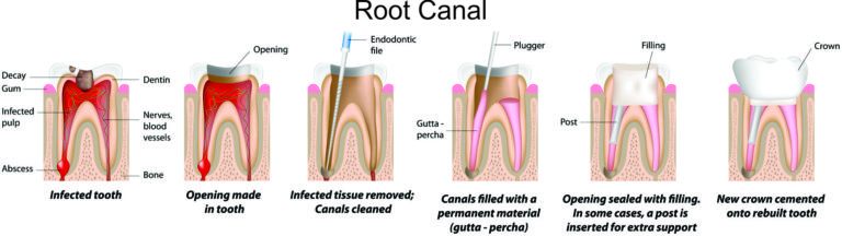 root-canal-treatment-in-portage-in-advanced-dental-concepts